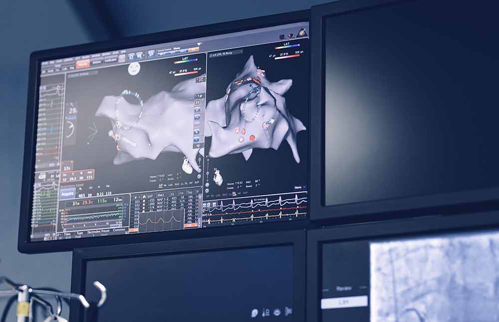Monitor displaying results and readings from a heart electroanatomic mapping tool